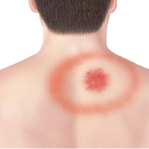 image of rash